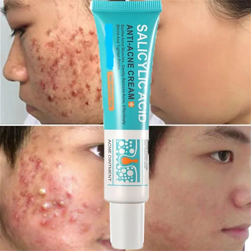 Salicylic Acid Acne Removal Cream for Clear Skin - كريم لإزالة حب الشباب بحمض الساليسيليك - يعمل على تصليح الاحمرار وبقع البثور وتنظيف المسام العميق والسيطرة على الزيت وترطيب البشرة