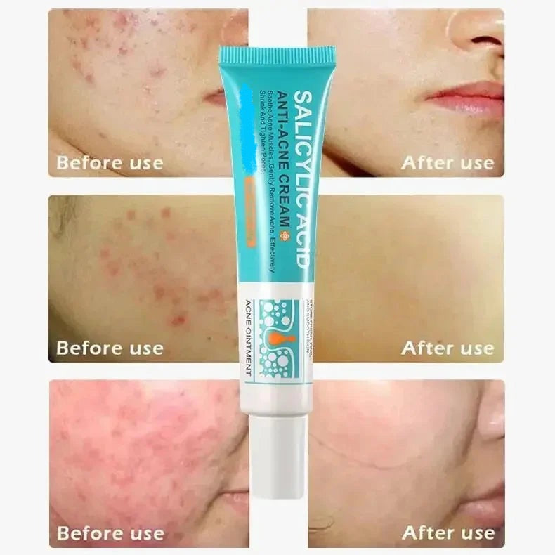 Salicylic Acid Acne Removal Cream for Clear Skin - كريم لإزالة حب الشباب بحمض الساليسيليك - يعمل على تصليح الاحمرار وبقع البثور وتنظيف المسام العميق والسيطرة على الزيت وترطيب البشرة