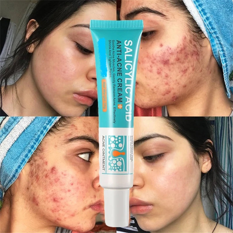 Salicylic Acid Acne Removal Cream for Clear Skin - كريم لإزالة حب الشباب بحمض الساليسيليك - يعمل على تصليح الاحمرار وبقع البثور وتنظيف المسام العميق والسيطرة على الزيت وترطيب البشرة