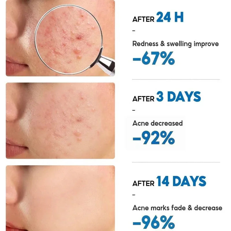 Salicylic Acid Acne Removal Cream for Clear Skin - كريم لإزالة حب الشباب بحمض الساليسيليك - يعمل على تصليح الاحمرار وبقع البثور وتنظيف المسام العميق والسيطرة على الزيت وترطيب البشرة