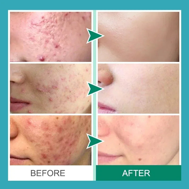 Salicylic Acid Acne Removal Cream for Clear Skin - كريم لإزالة حب الشباب بحمض الساليسيليك - يعمل على تصليح الاحمرار وبقع البثور وتنظيف المسام العميق والسيطرة على الزيت وترطيب البشرة