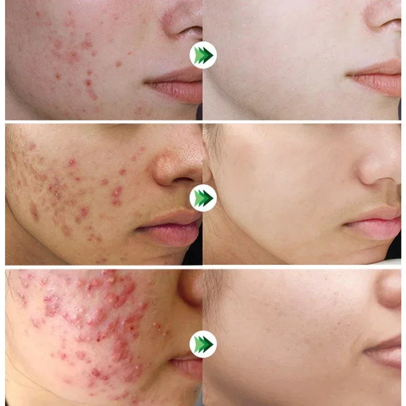 Salicylic Acid Acne Removal Cream for Clear Skin - كريم لإزالة حب الشباب بحمض الساليسيليك - يعمل على تصليح الاحمرار وبقع البثور وتنظيف المسام العميق والسيطرة على الزيت وترطيب البشرة